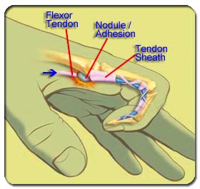 Causes of Trigger Finger