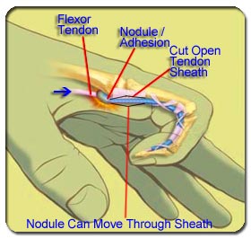 Treatments for Trigger Finger Syndrome